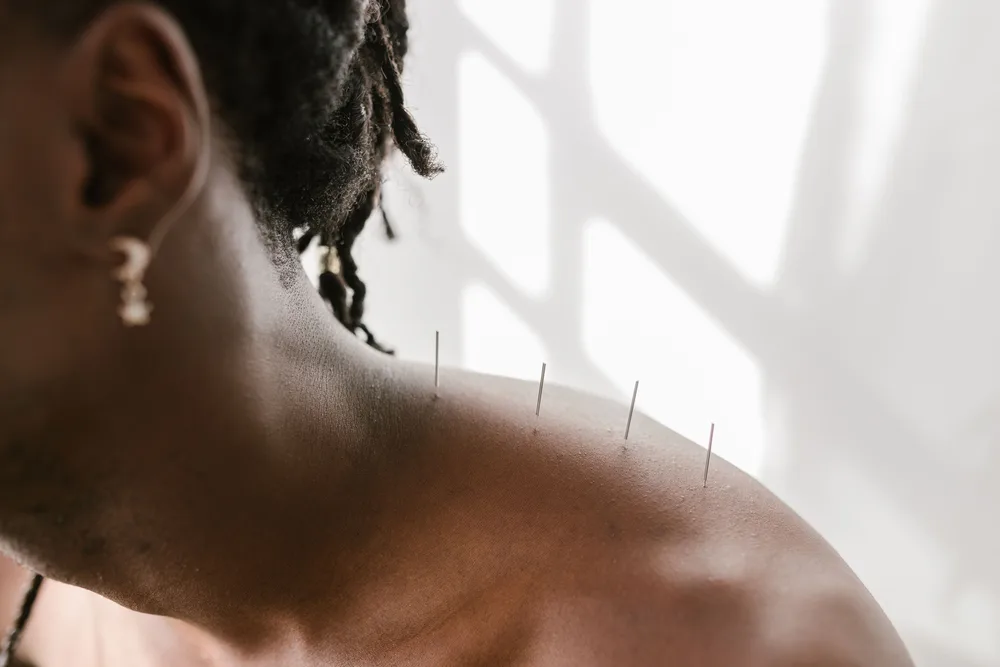 A row of fine acupuncture needles placed along a woman's shoulder and upper back in bright daylight.