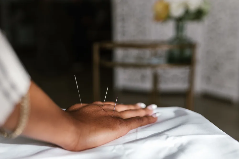 Fine acupuncture needles placed in a person's hand resting on a white sheet in a calm treatment room.