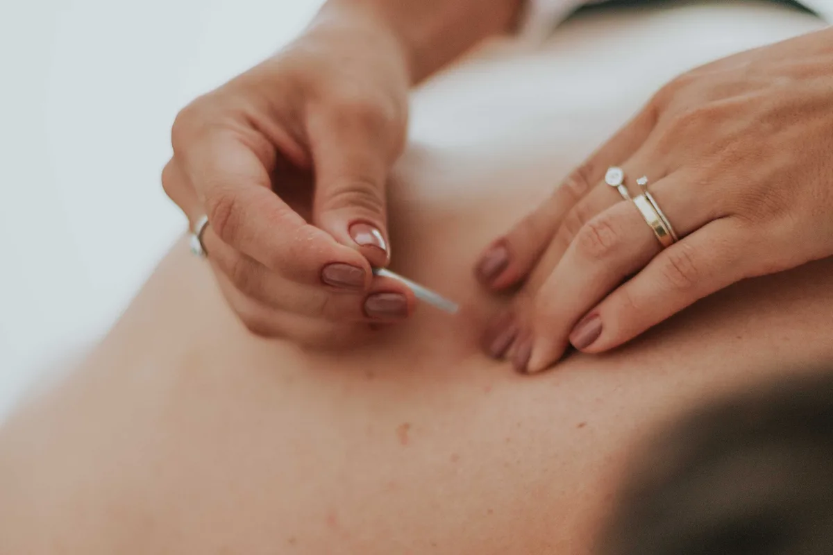 An acupuncturist's hands placing a fine needle into a person's upper back during a treatment session.